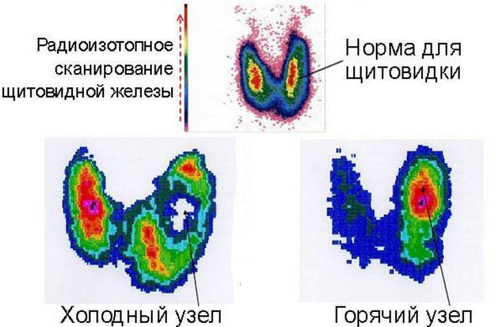 Усиление сосудистого рисунка щитовидной железы что это значит