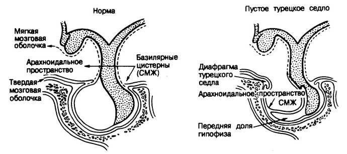 Что такое турецкое седло у детей