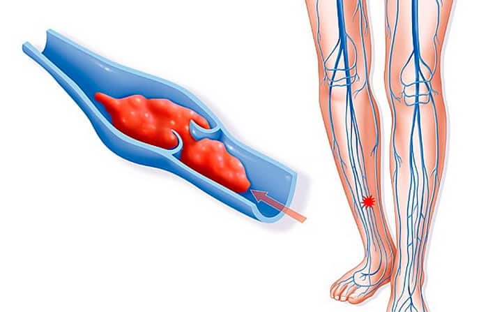 онемение ноги от колена до стопы при болезнях с сосудами