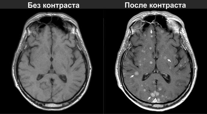 мрт головного мозга с контрастом кому показано