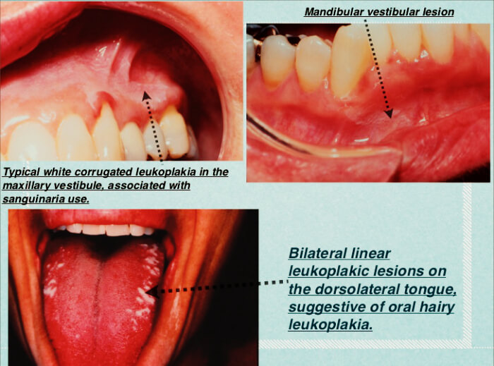 Лейкоплакия полости рта фото лечение