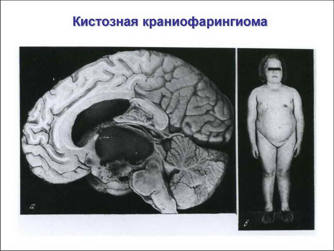 что такое краниофарингиома головного мозга