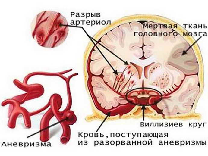 Аневразма головного мозга небольших размеров 