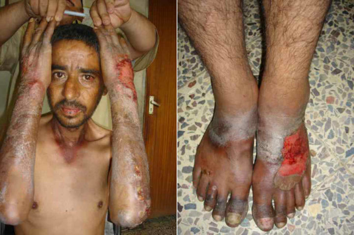 Фото кожных проявлений болезни Хартнупа