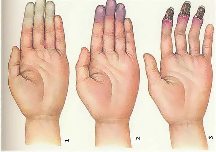 При болезни рейно немеют пальцы рук