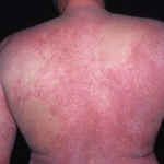 Как выглядит аллергический дерматит фото