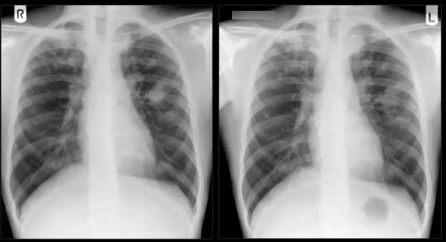 Рентгеновские снимки грудной клетки