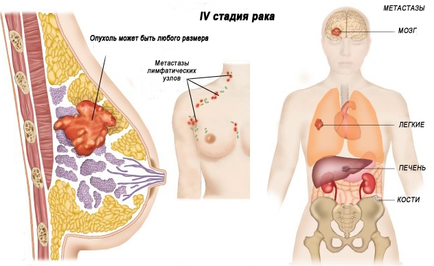 Рак молочной железы 4 стадия