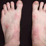 фото дерматита на ступнях ног