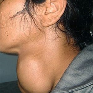 Что такое дтз щитовидной железы 