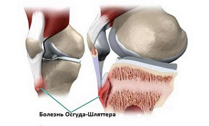 остеохондроз коленного сустава классификация