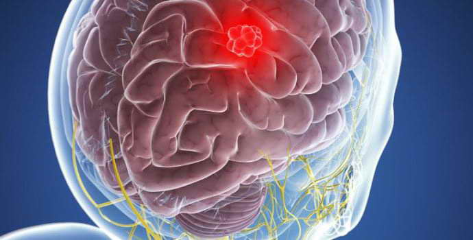 Симптомы и методы лечения менингиомы головного мозга