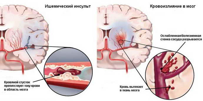 инсульт геморрагический левая сторона лечение
