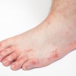 аллергический дерматит на ногах фото