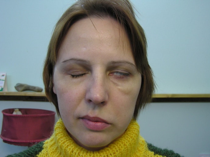 Как лечить застуженый лицевой нерв