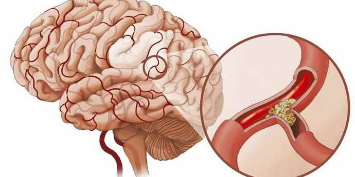 Терапия кровеносных сосудов в мозгу