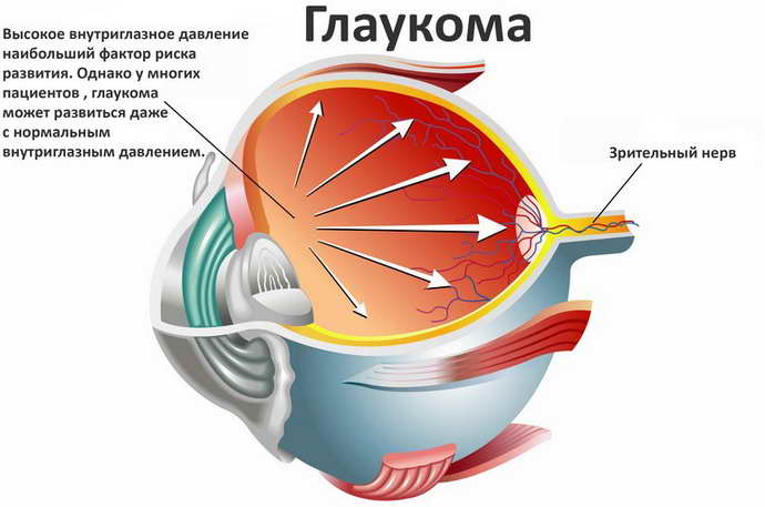 как возникает двоение в глазах при шейном остеохондрозе