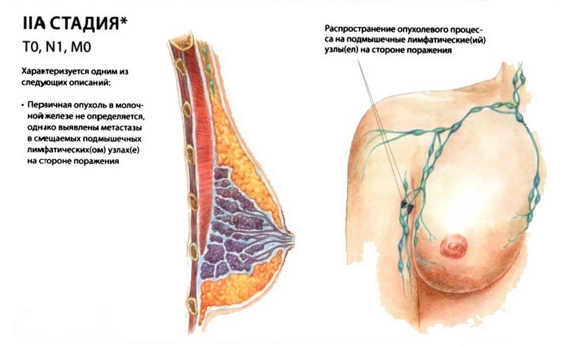 Рак молочной железы 2 стадия