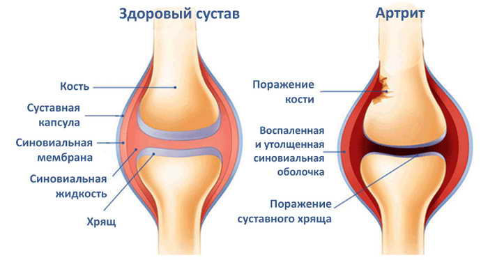 защемление нерва в плечевом суставе особенности