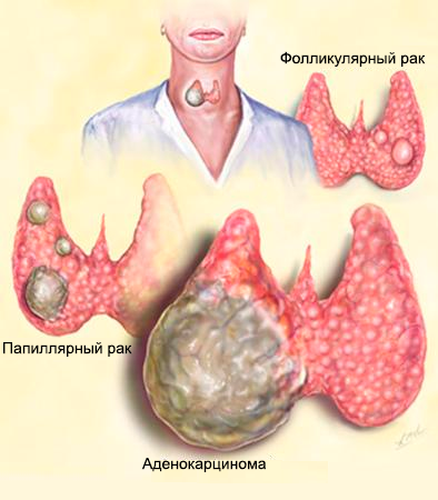 сколько живут при раке щитовидной железы
