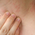 фото аллергического дерматита на шее
