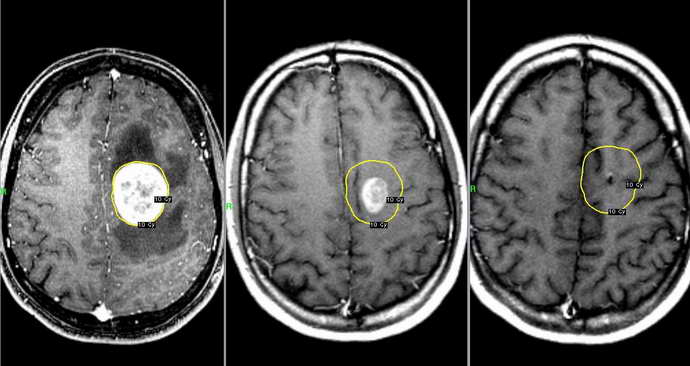 Проявление опухоли головного мозга на МРТ