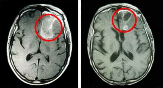 Глиома мозга является внутричерепной опухолью