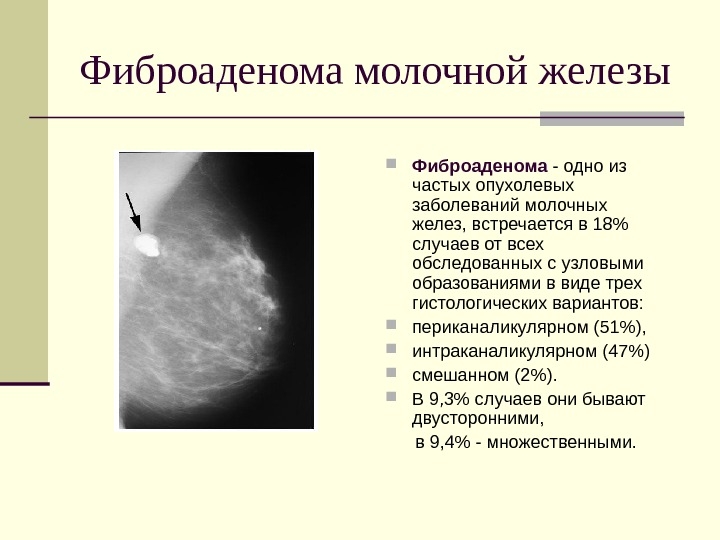 Фиброаденома молочной железы