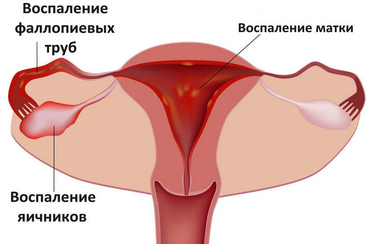 Воспаление яичников и придатков у женщин