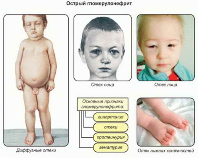 Реферат: Одномерная эхоэнцефалография и повышение внутричерепного давления у детей