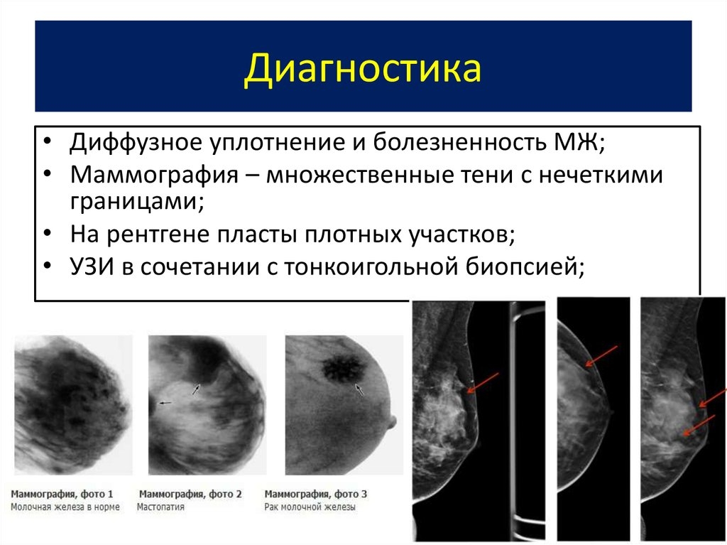Маммография фкм. Фиброзно кистозная мастопатия маммограмма. Кистозная мастопатия маммография. Диффузная фиброзно-кистозная мастопатия маммограмма. Фиброзно-кистозная мастопатия молочных желез на маммографии.
