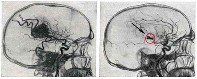 ангиома головного мозга классификация
