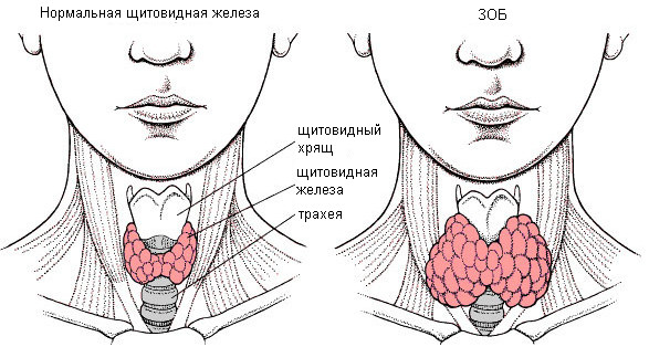 узловой нетоксический зоб щитовидной железы