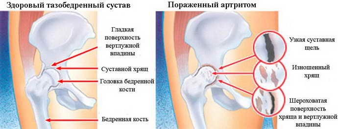 что такое остеохондроз тазобедренного сустава