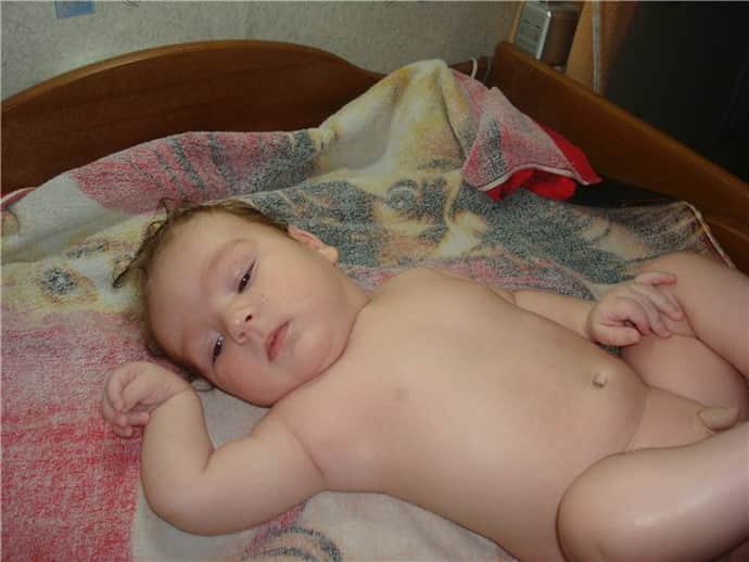 Виды и причины акушерских параличей у новорожденных