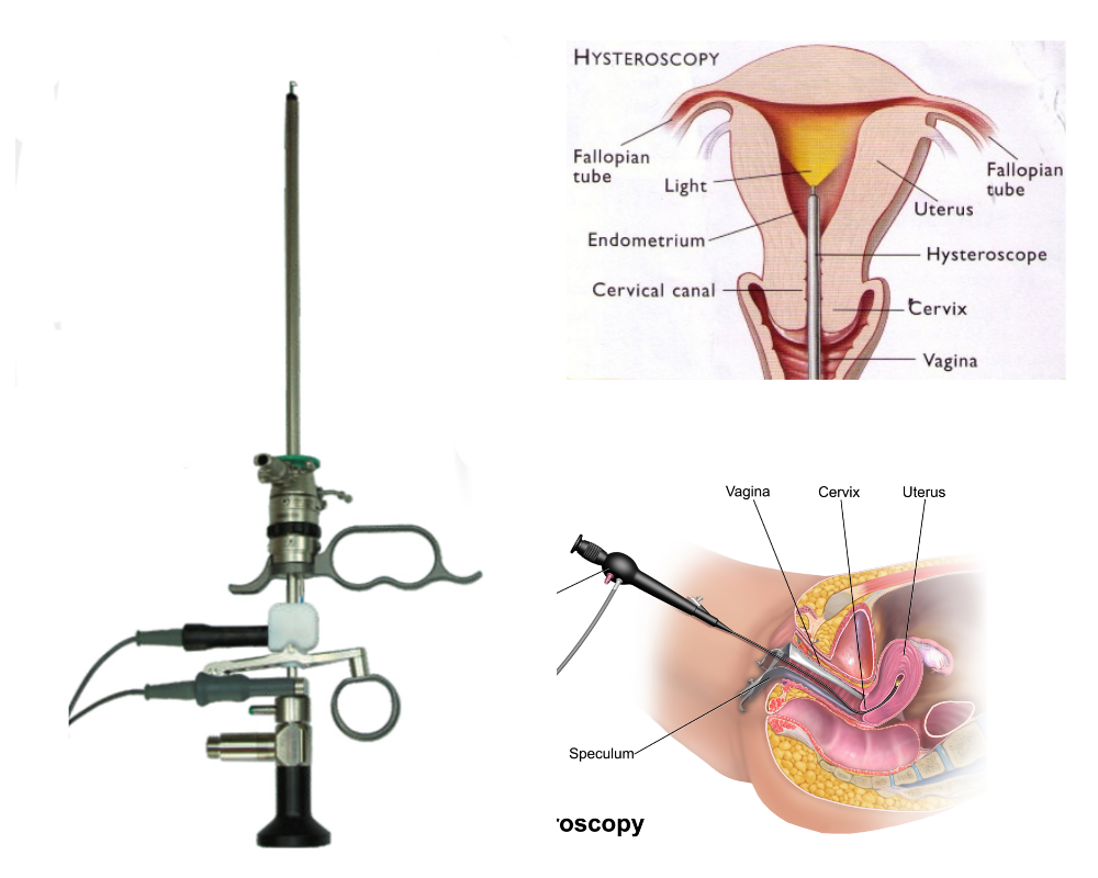 Гистероскоп и процедура гистероскопии