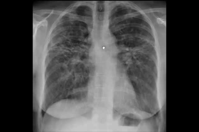 Рентгеновский снимок легких