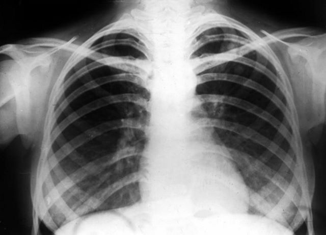 Очаговый туберкулёз левой и правой части лёгкого грудной клетки