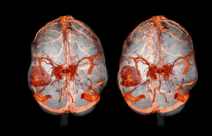Компьютерная томография головного мозга