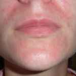 Фото аллергического дерматита на лице