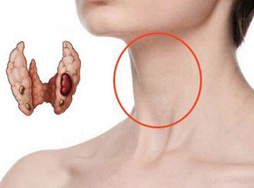 киста щитовидки