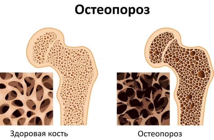 Остеопороз при миопатии