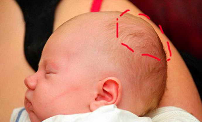 отек мозга у новорожденного формы