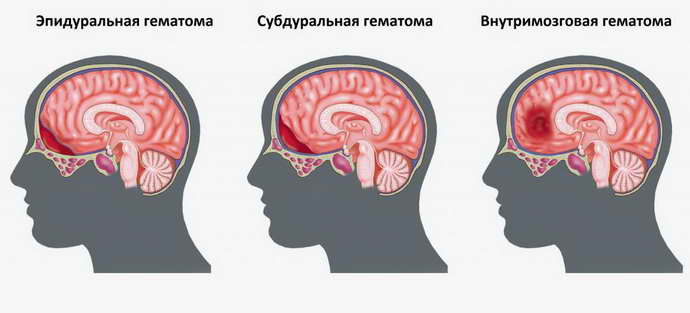 гематома головного мозга виды
