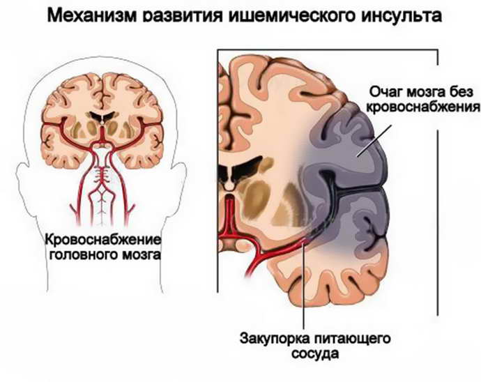 острое гипоксическое поражение мозга