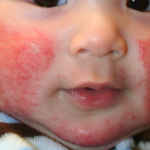 Фото аллергического дерматита на лице у ребенка