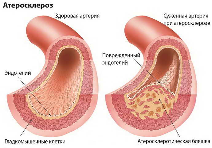 грудной остеохондроз