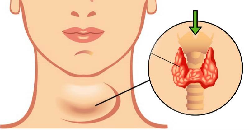 Восстановление голоса после удаления щитовидной железы