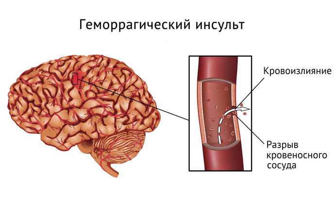 инсульт мозжечка каким он бывает