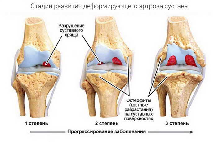 остеохондроз коленного сустава